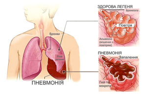 У чому різниця між запаленням легень і пневмонією? Пояснення тут