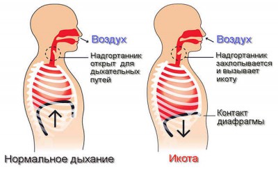 Чому виникає гикавка: основні причини та як її позбутися?