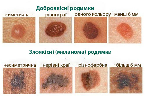 Перевірити родимку в Києві: найкращі клініки та поради від експертів