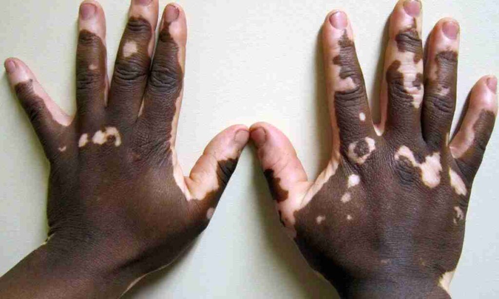 Чому виникає аддисонова (бронзова) хвороба: причини та симптоми? Чому виникає аддисонова (бронзова) хвороба: причини та симптоми?