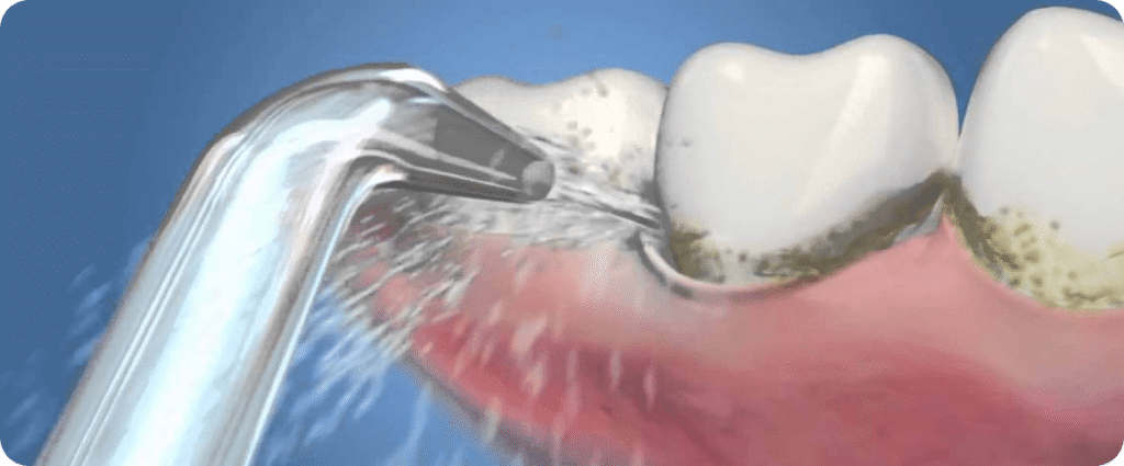 Для чого потрібен іригатор: основні переваги та користь для зубів